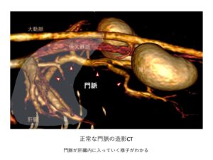 正常な門脈の造営CT
